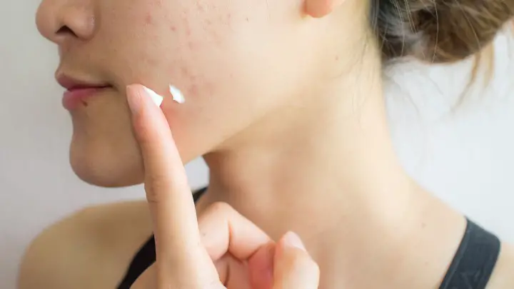 does hyaluronic acid help acne - serum 101