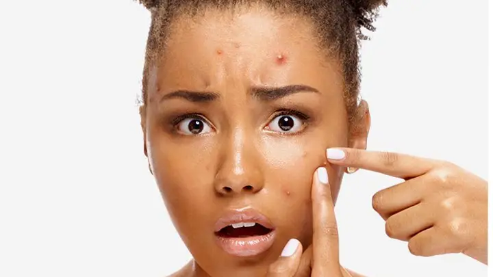How to use Retin A for acne