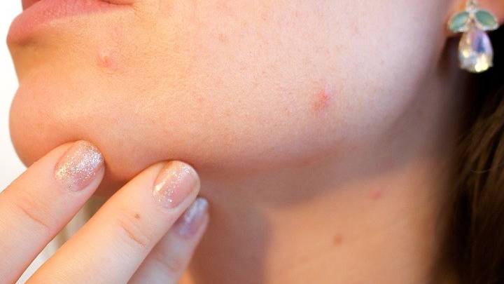 do-retonoids-help-with-acne-serum101